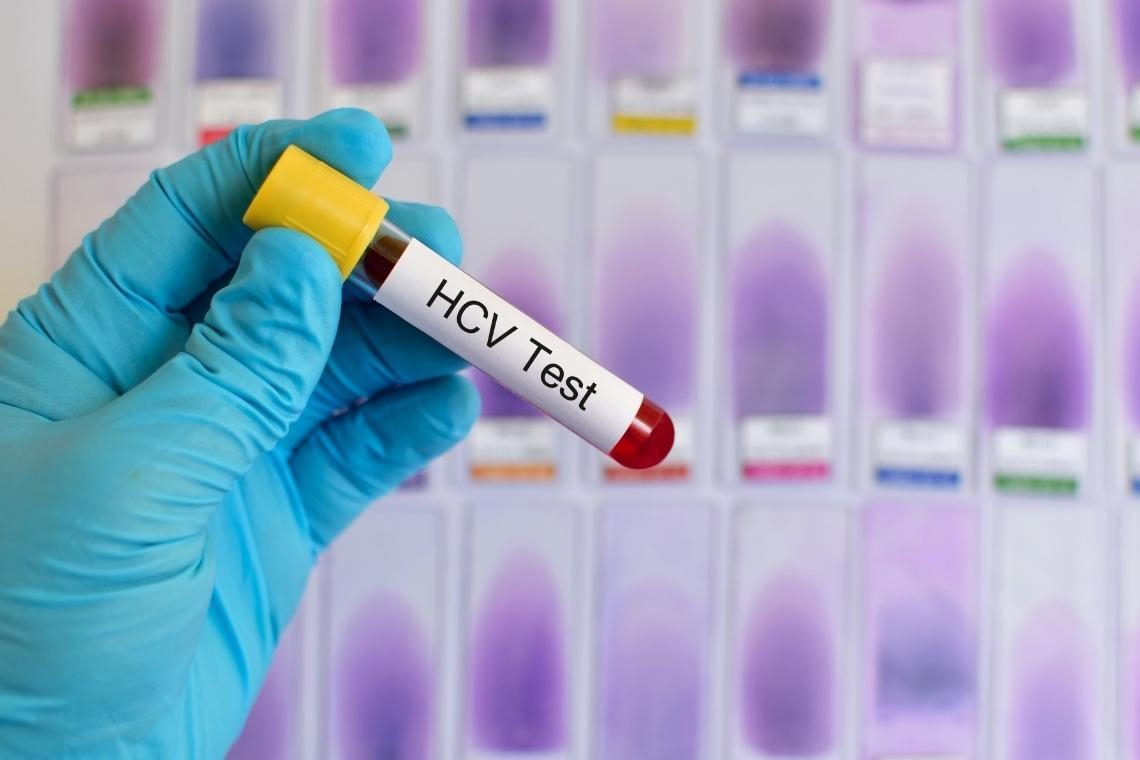 Začenja se brezplačno testiranje na hepatitis C
